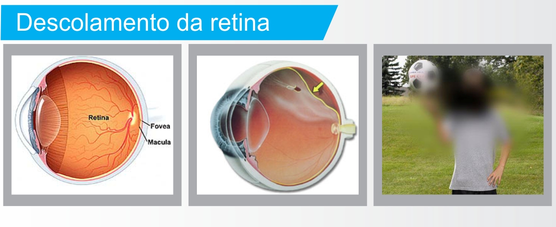 Inforgráfico descolamento de retina (tratamento em Curitiba)
