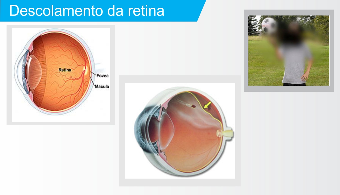 descolamento da retina curitiba