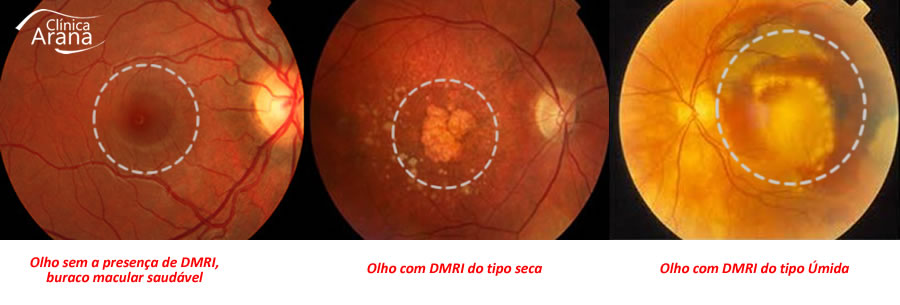 À direita olho saudável, no centro DMRI do tipo seca e à direita DMRI do tipo úmida